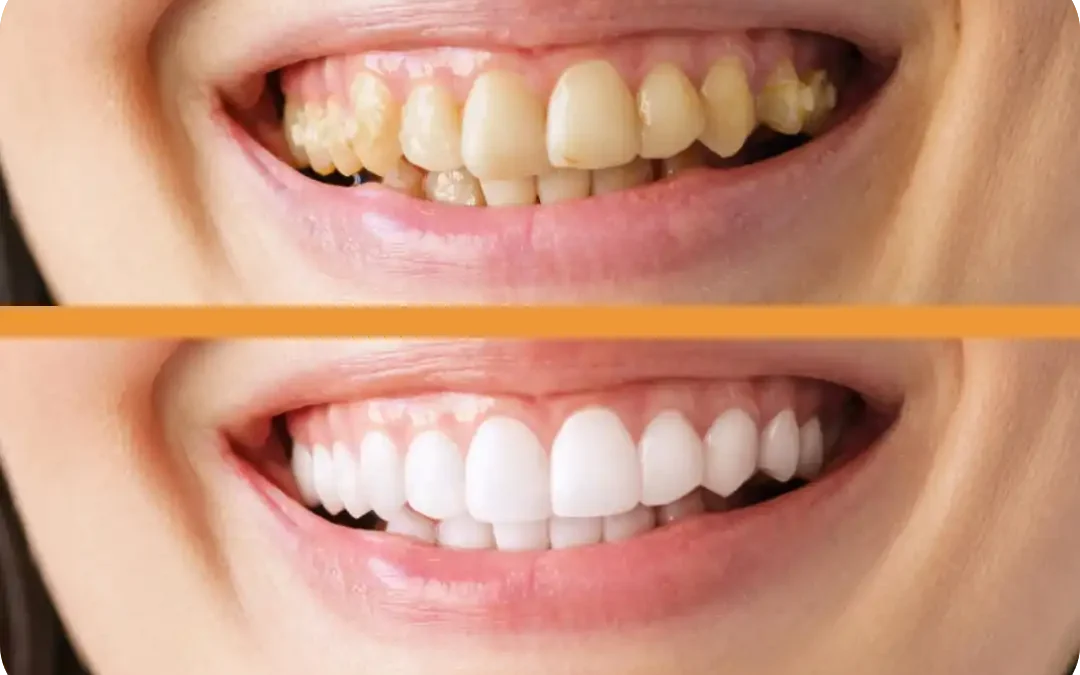 Sbiancamento dentale fai-da-te sotto accusa: non sostituisce i dentisti!