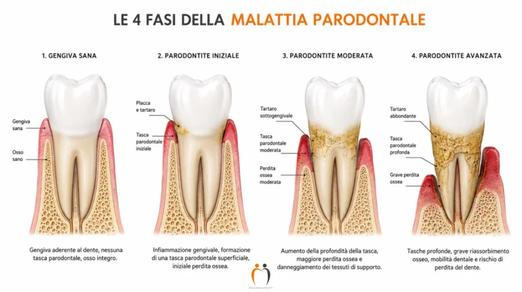fasi della parodontite schema clinico da lieve ad avanzata