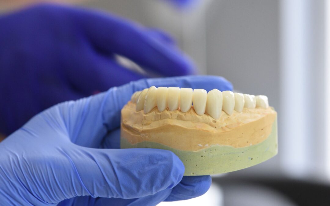 Ricostruzione dente devitalizzato con corona in ceramica presso Studio Miggiano Rivetti